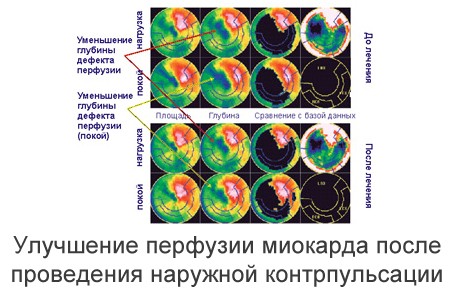 Аппарат усиленной наружной контрпульсации Chongqing PSK-Health P-ECP/TI (КНР)