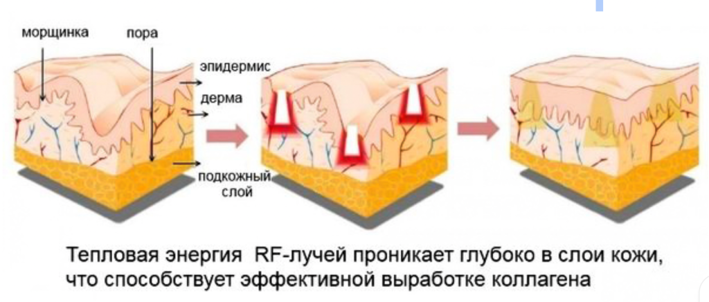 Воздействие радиоволновых лучей на кожу и ткани