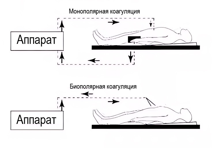 Монополярная и биполярная коагуляция