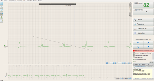 Программа для ЭКГ покоя BTL CardioPoint-ECG C600