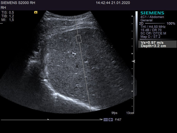 Аппарат УЗИ (сканер) Siemens Healthineers Acuson S2000
