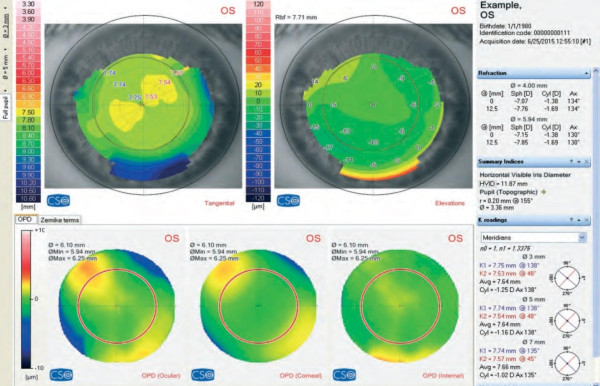 Корнеотопограф Schwind Combi wavefront analyzer