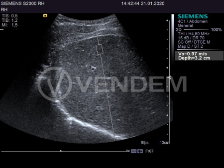 Аппарат УЗИ (сканер) Siemens Healthineers Acuson S2000