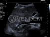 Аппарат УЗИ (сканер) Siemens Healthineers Acuson P500