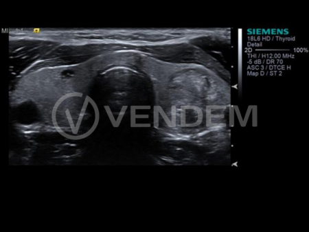 Аппарат УЗИ (сканер) Siemens Healthineers Acuson S3000